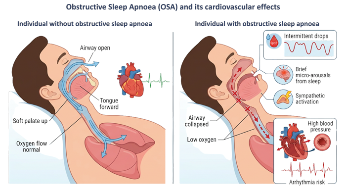 The Hidden Link Between Sleep Apnoea And Heart Health